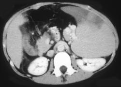 Splenic Infarction - CTisus CT Scan