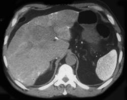 Thorotrast Liver and Spleen - CTisus CT Scan