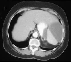 Subcapsular Hematoma - CTisus CT Scan