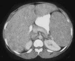 Sarcoidosis Spleen and Liver - CTisus CT Scan