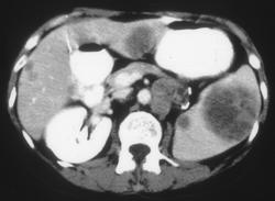 Metastases to the Spleen and Liver With Nodes (renal Cell Carcinoma) - CTisus CT Scan