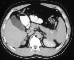 Carcinoma of the Tail of the Pancreas Invades the Spleen - CTisus CT Scan