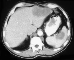 Implants on the Spleen Due to Ovarian Cancer - CTisus CT Scan