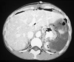 Splenic Infarction - CTisus CT Scan