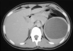 Splenic Cyst - CTisus CT Scan