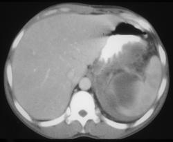 Pancreatitis Extends Into the Spleen - CTisus CT Scan