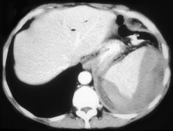 Subcapsular Hematoma-chronic Pancreatitis - CTisus CT Scan