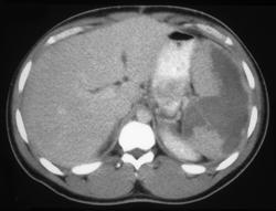 Splenic Infarction - CTisus CT Scan