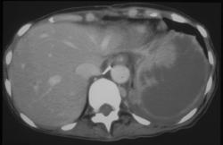 Splenic Infarction S/P Trauma and Repair - CTisus CT Scan