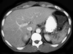 Tuberculosis (TB) Spleen - CTisus CT Scan