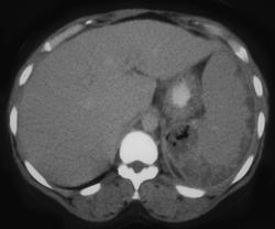 Splenic Abscess - CTisus CT Scan