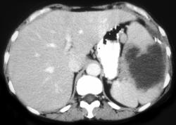 Metastases to the Spleen From Ovarian Cancer - CTisus CT Scan