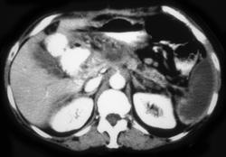 Splenic Infarction W/pancreatic Cancer - CTisus CT Scan