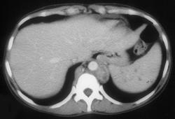 Mai Spleen With Nodes - CTisus CT Scan