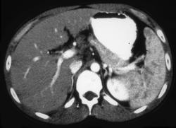 Mai-infection Spleen - CTisus CT Scan