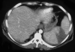 Splenic Infarction - CTisus CT Scan