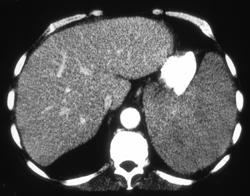 Lymphoma - CTisus CT Scan