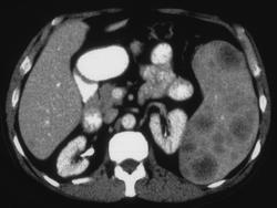 Gauchers Simulates Lymphoma - CTisus CT Scan