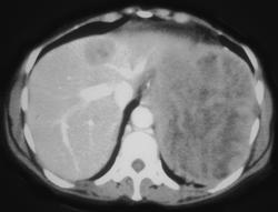 Retroperitoreal Sarcoma Invades the Spleen - CTisus CT Scan