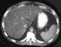 Splenic Laceration W/bleed - CTisus CT Scan