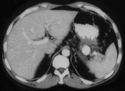 Splenic Artery-pseudoaneurysm - CTisus CT Scan