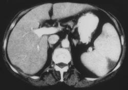 Splenic Infarction - CTisus CT Scan