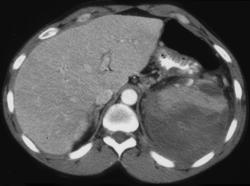 Splenic Rupture - CTisus CT Scan