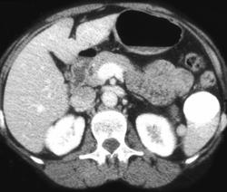 Calcified Cyst - CTisus CT Scan