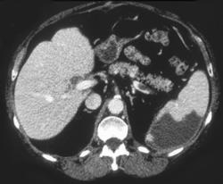 Splenic Infarction - CTisus CT Scan