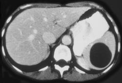 Splenic Cyst - CTisus CT Scan