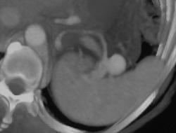 Splenic Artery Aneurysm - CTisus CT Scan