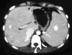 Splenic Hemangioma - CTisus CT Scan