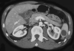 Splenic Hemangioma - CTisus CT Scan