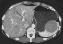 Splenic Hemangioma - CTisus CT Scan