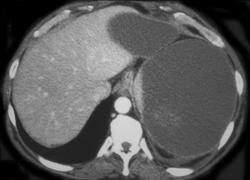 Subcapsular Bleed - CTisus CT Scan