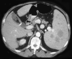 Lymphoma - CTisus CT Scan