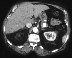 Splenic Artery Aneurysm - CTisus CT Scan