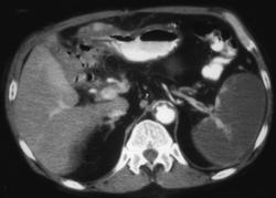 Splenic Infarction - CTisus CT Scan