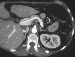 Accessory Spleen - CTisus CT Scan