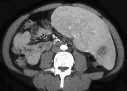 Acute Hemorrhagic Splenic Infarction - CTisus CT Scan