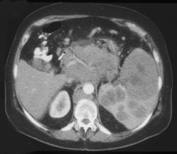 Splenic Lymphoma - CTisus CT Scan