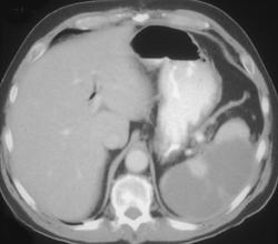 Splenic Infarction - CTisus CT Scan