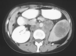 Metastases From Renal Cell Carcinoma - CTisus CT Scan