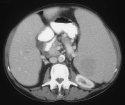 Lymphoma - CTisus CT Scan