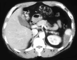 Splenic Infarction - CTisus CT Scan