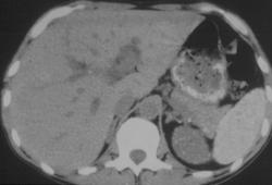 Pneumocystis Spleen and Kidney - CTisus CT Scan