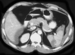 Splenic Laceration - CTisus CT Scan