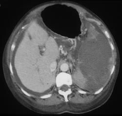 Splenic Lymphoma - CTisus CT Scan