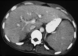 Splenic Lymphoma - CTisus CT Scan