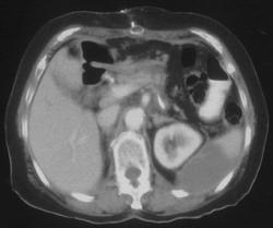 Splenic Infarction - CTisus CT Scan